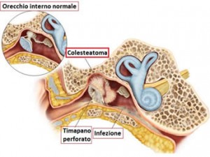 colesteatoma-orecchio-medio