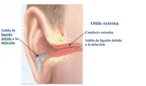 otitis-externa1